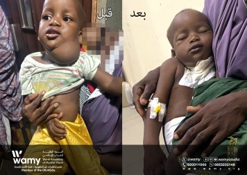 قافلة الندوة الجراحية تنجح في إنقاذ رضيع في نيجيريا