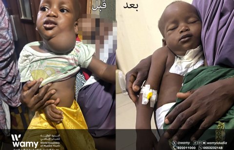 قافلة الندوة الجراحية تنجح في إنقاذ رضيع في نيجيريا