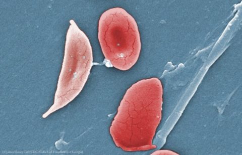 مرض خلايا الدم المنجلية
